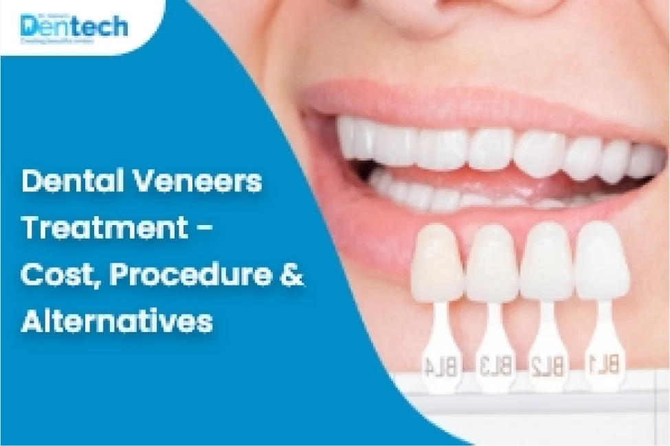 Dental Veneers Treatment Cost in Mumbai